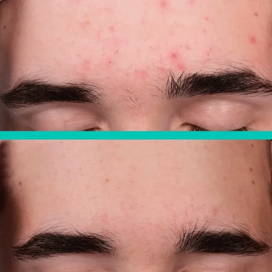 LUNA MICROCARE FLAWLESS Spuogus/akne šalinančių pleistrų rinkinys
